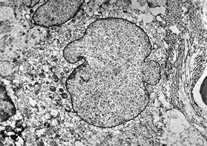 M,14y. | eosinophilic granuloma - lung M,14y. | eosinophilic granuloma - lung
